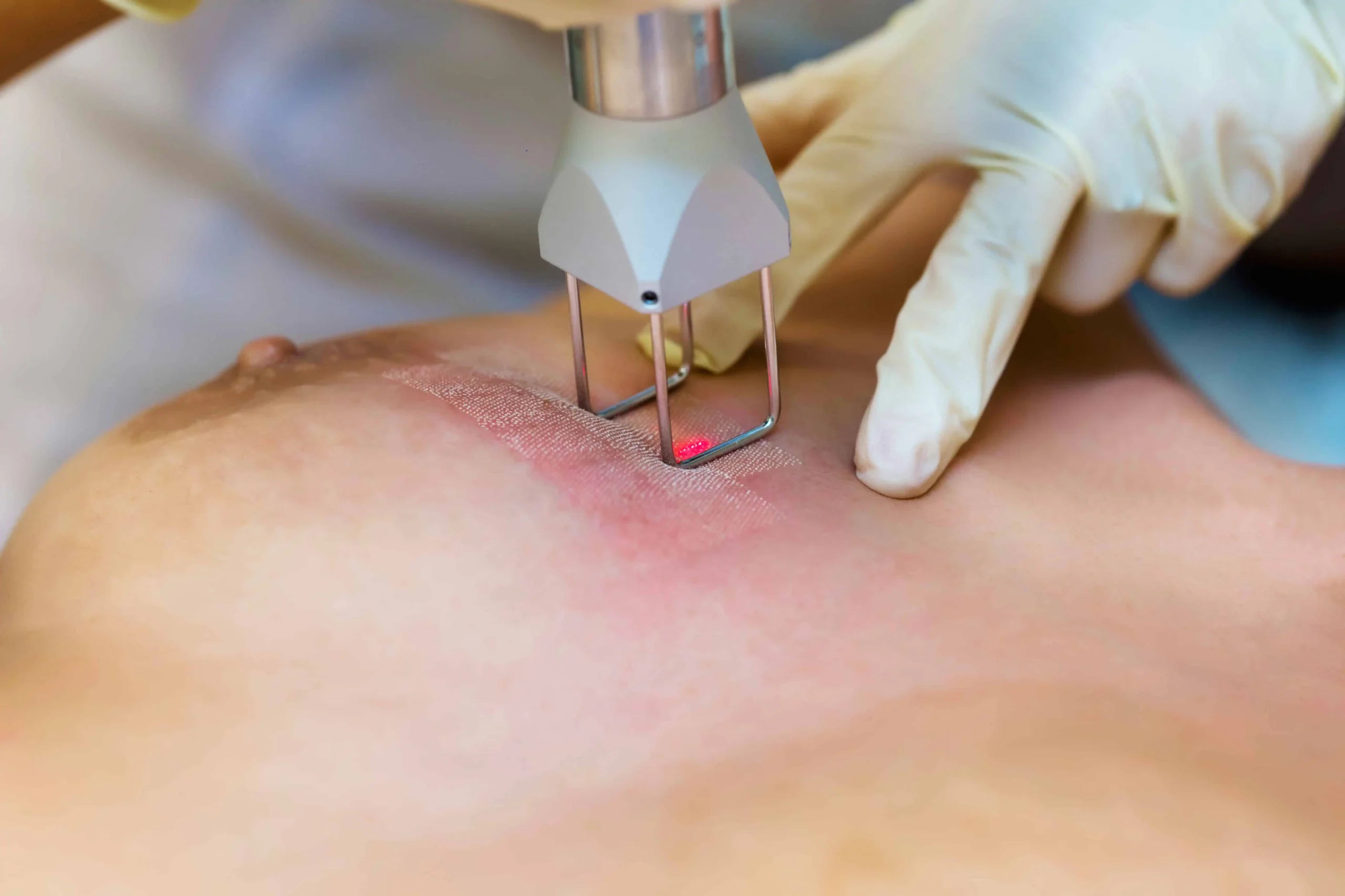 Reveal Smoother, Clearer Skin — Stretch Mark Removal That Fades Scars & Restores Confidence